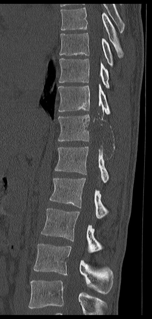 Aneurysmal bone cyst T11 (Radiopaedia 29294-29721 Sagittal bone window 43).jpg