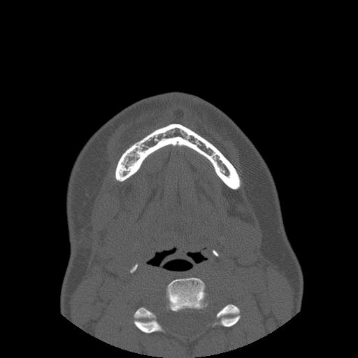 File:Aneurysmal bone cyst of the mandible (Radiopaedia 43280-46823 Axial bone window 25).jpg