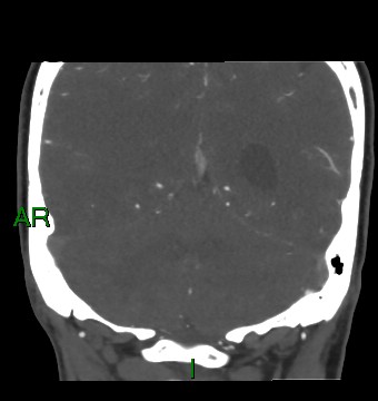 Aneurysmal subarachnoid hemorrhage with intra-axial extension (Radiopaedia 84371-99732 C 33).jpg