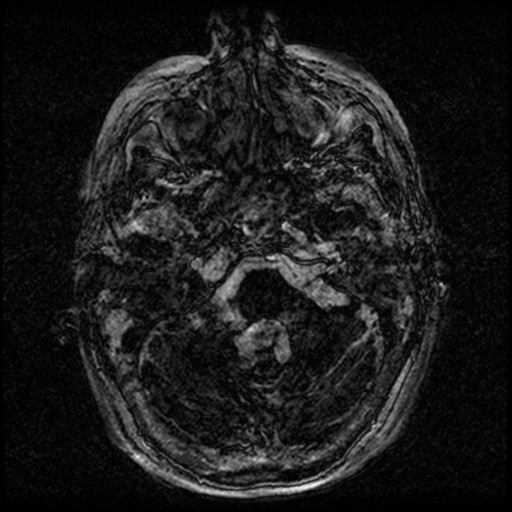 Angioinvasive aspergillosis in the pituitary fossa (Radiopaedia 39676-42010 Ax 3D FIESTA VOLUME 8).png