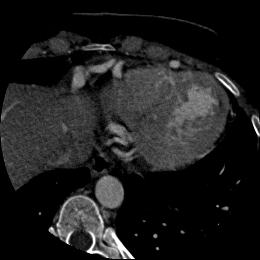 Anomalous left coronary artery from the pulmonary artery (ALCAPA) (Radiopaedia 40884-43586 A 74).jpg