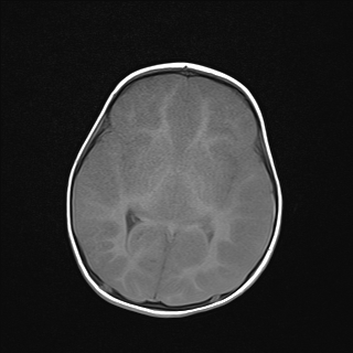 File:Anoxic brain injury (Radiopaedia 79165-92139 Axial T1 14).jpg