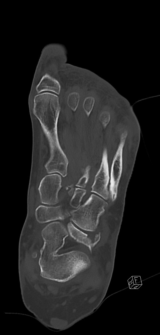 Anterior calcaneal process fracture (Radiopaedia 63353-71943 Coronal bone window 26).jpg