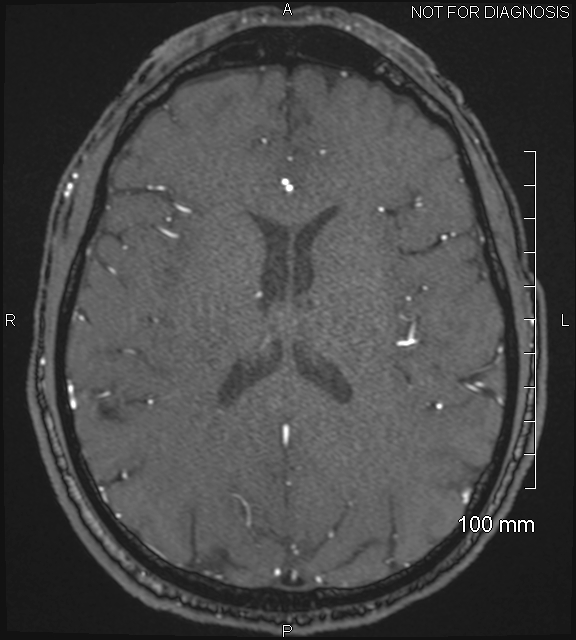 Anterior cerebral artery aneurysm (Radiopaedia 80683-94127 Axial MRA 150).jpg