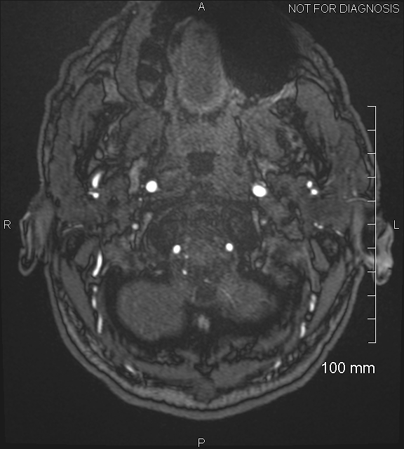 Anterior cerebral artery aneurysm (Radiopaedia 80683-94127 Axial MRA 5).jpg