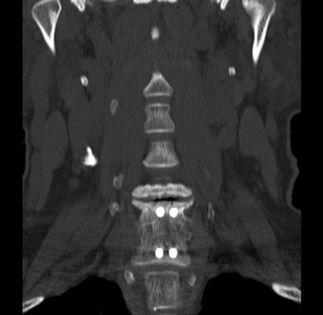 Anterior cervical postdiscectomy arthrodesis (Radiopaedia 32678-33646 Coronal bone window 15).jpg