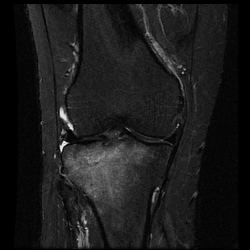 File:Anterior cruciate ligament avulsion fracture (Radiopaedia 58939-66193 Coronal STIR 10).jpg