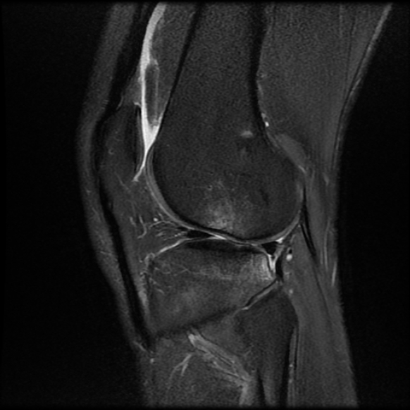 File:Anterior cruciate ligament graft tear and bucket-handle tear of medial meniscus (Radiopaedia 75867-87254 Sagittal PD fat sat 21).jpg