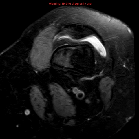 File:Anterior cruciate ligament tear (Radiopaedia 12329-12612 Axial T2 fat sat 20).jpg