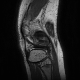 Anterior cruciate ligament tear - pediatric (Radiopaedia 62152-70260 Sagittal PD 148).jpg
