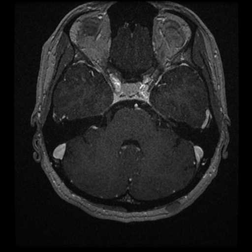 Anterior inferior cerebellar artery vascular loop - type II (Radiopaedia 70991-81209 Axial T1 C+ 29).jpg
