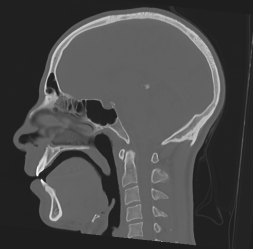 Anterior nasal spine fracture (Radiopaedia 46138-50494 Sagittal bone window 30).png