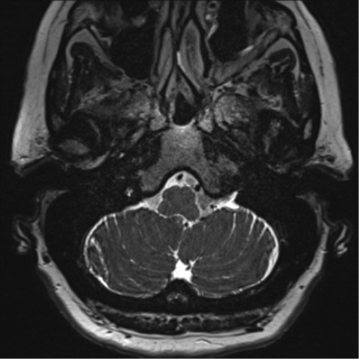 Anterior temporal pole cysts (Radiopaedia 46629-51102 Axial T2 14).png