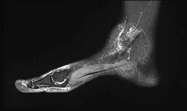 File:Anterior tibial artery false aneurysm (Radiopaedia 88984-105808 Sagittal STIR 23).jpg