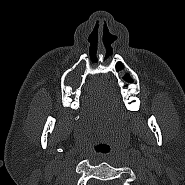 Antrochoanal polyp (Radiopaedia 30002-30554 Axial bone window 11).jpg