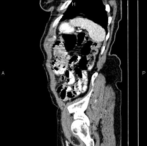 File:Aortic aneurysm and Lemmel syndrome (Radiopaedia 86499-102554 D 78).jpg