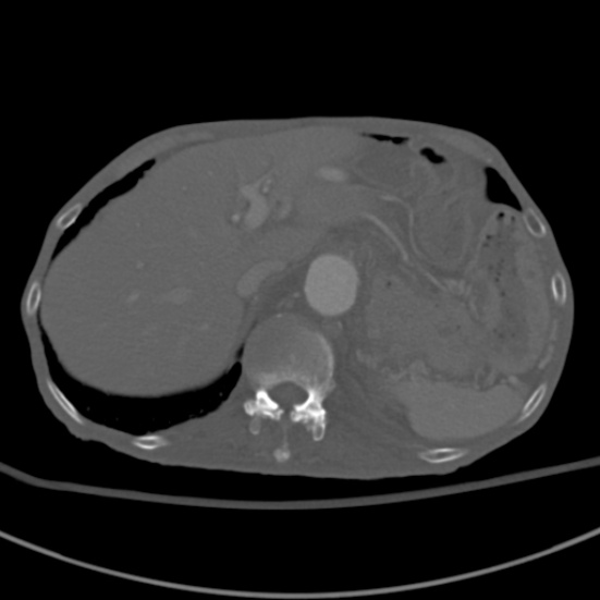 Aortic aneurysm with spinal destruction (Radiopaedia 42301-45410 Axial bone window 19).jpg