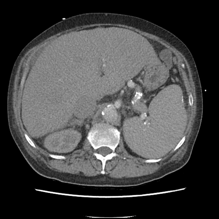 Aortic arch graft infection (FDG PET-CT) (Radiopaedia 71975-82437 A 65).jpg