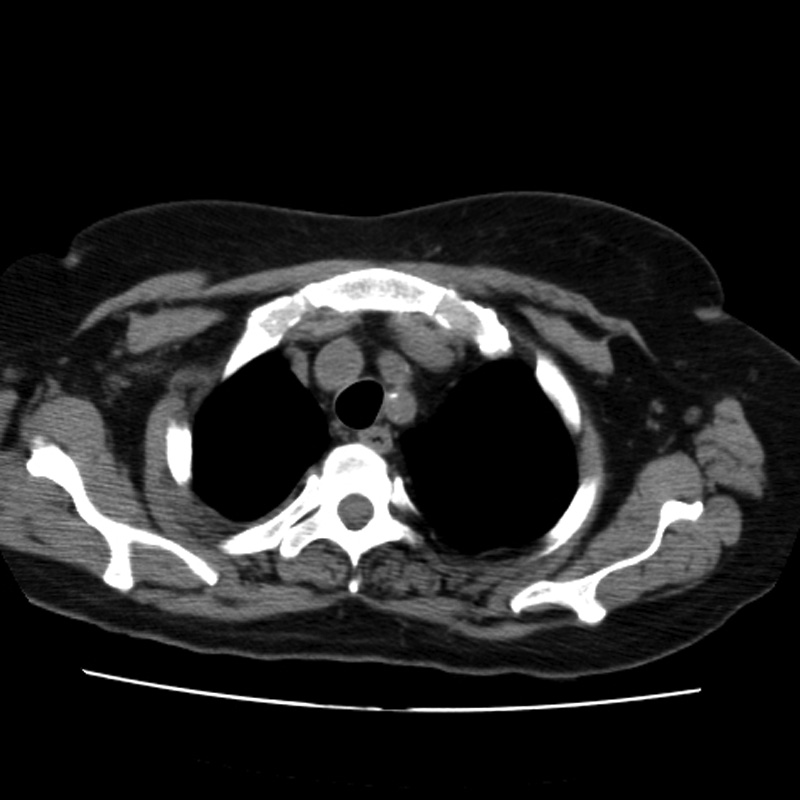 Aortic arch pseudoaneurysm (Radiopaedia 8534-9368 Axial non-contrast 9).jpg