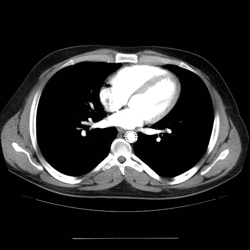 File:Aortic arch stent (Radiopaedia 30030-30595 D 23).jpg