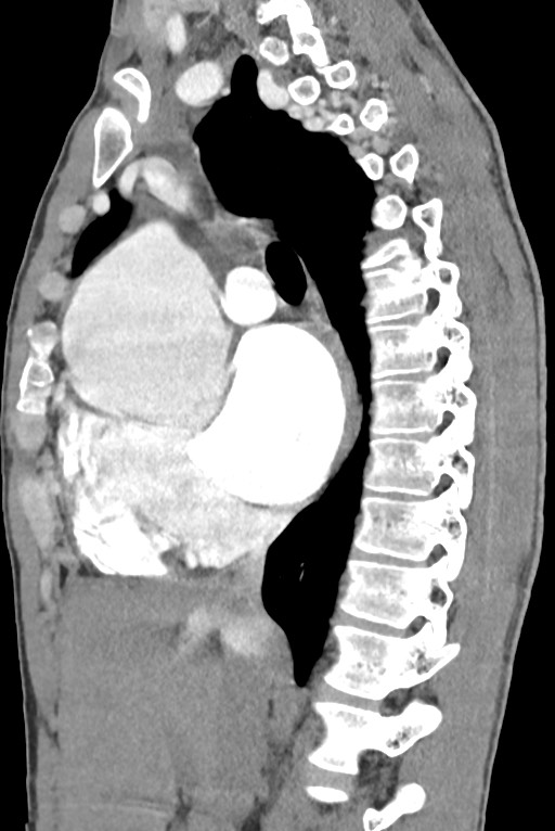 Aortic coarctation with aneurysm (Radiopaedia 74818-85828 B 73).jpg