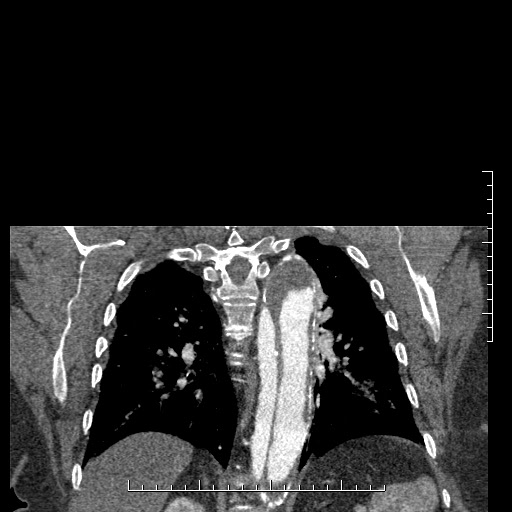 Aortic dissection- Stanford A (Radiopaedia 35729-37268 E 6).jpg