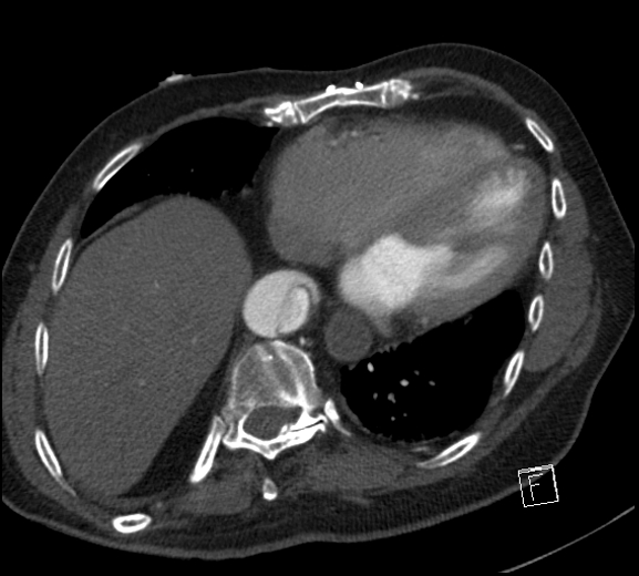 File:Aortic dissection (CTPA) (Radiopaedia 75506-86750 A 69).jpg