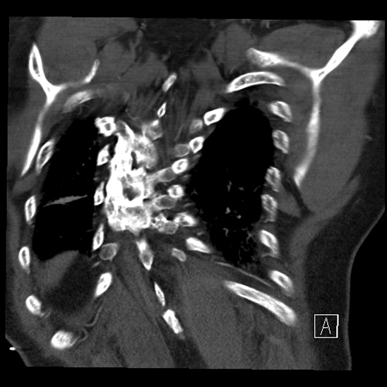 File:Aortic dissection (CTPA) (Radiopaedia 75506-86750 B 65).jpg