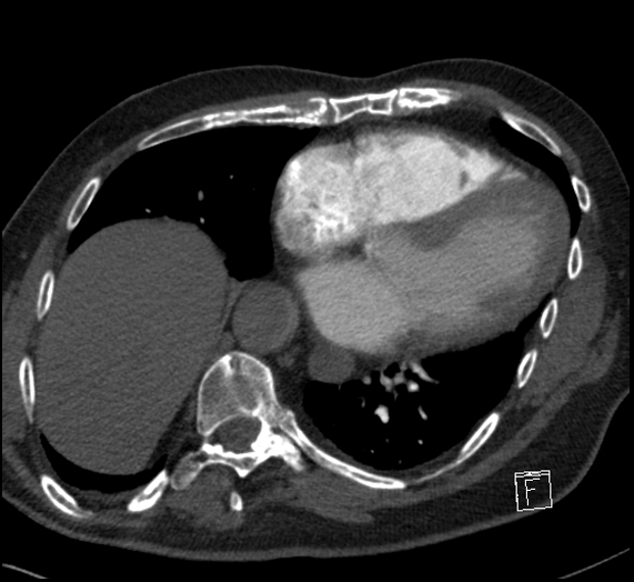 File:Aortic dissection (CTPA) (Radiopaedia 75506-86751 Axial C+ CTPA 93).jpg