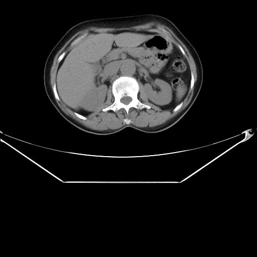 Aortic dissection (Radiopaedia 25350-25604 B 45).jpg