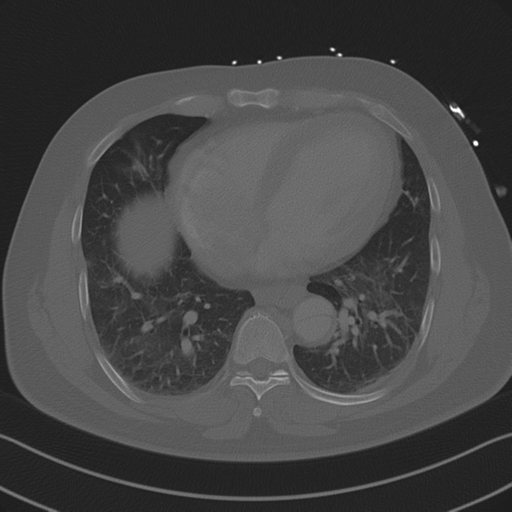 File:Aortic dissection (Radiopaedia 50763-56234 Axial bone window 70).png