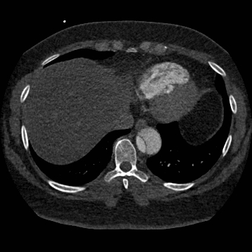 Aortic dissection (Radiopaedia 57969-64959 A 237).jpg