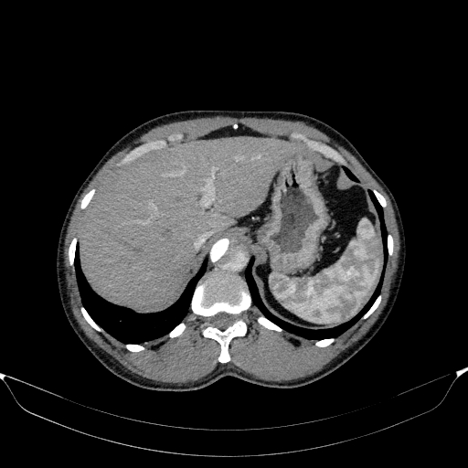 Aortic dissection - Stanford type A (Radiopaedia 83418-98500 A 59).jpg