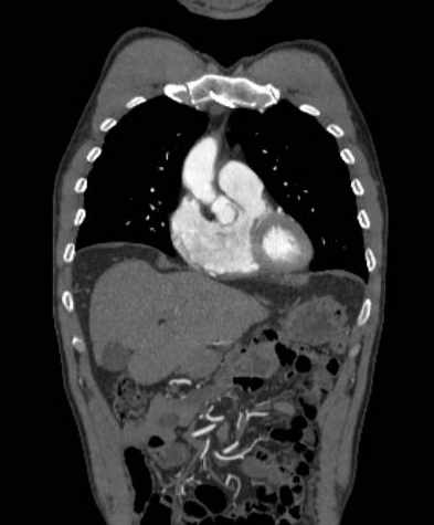 File:Aortic dissection - Stanford type B (Radiopaedia 73648-84437 B 35).jpg
