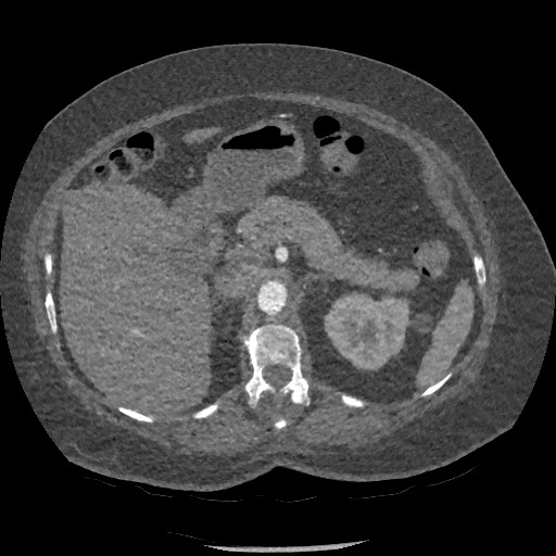 File:Aortic dissection - Stanford type B (Radiopaedia 88281-104910 A 109).jpg