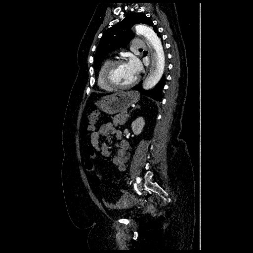 Aortic dissection - Stanford type B (Radiopaedia 88281-104910 C 55).jpg
