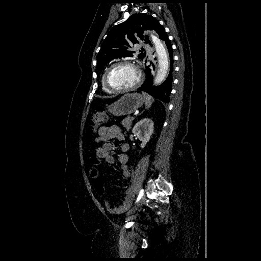 Aortic dissection - Stanford type B (Radiopaedia 88281-104910 C 60).jpg