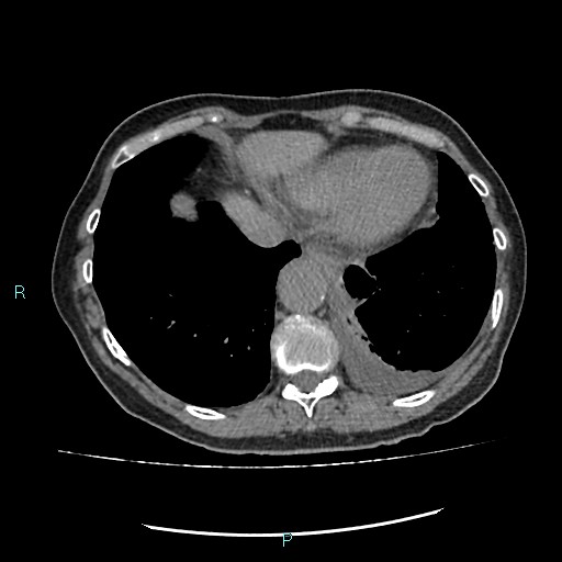 File:Aortic dissection extended to lusory artery (Radiopaedia 43686-47136 Axial non-contrast 23).jpg