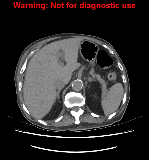 Aortic graft infection (Radiopaedia 44979-48907 Axial non-contrast 31).jpg