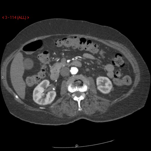 Aortic intramural hematoma (Radiopaedia 27746-28001 A 114).jpg