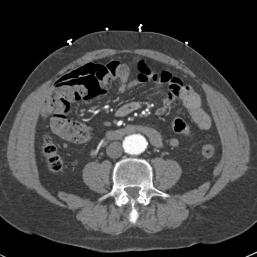 Aortic intramural hematoma (Radiopaedia 31139-31838 B 117).jpg