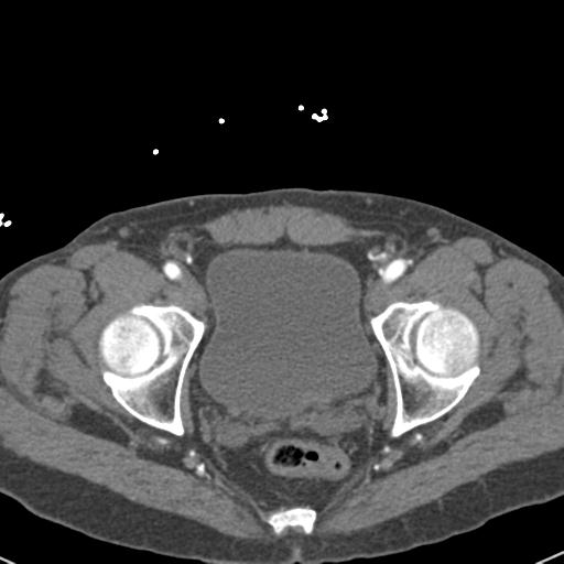 Aortic intramural hematoma (Radiopaedia 31139-31838 B 160).jpg