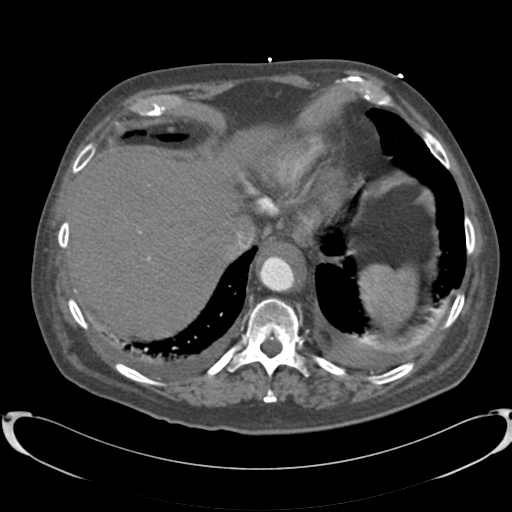 Aortic intramural hematoma (Radiopaedia 34260-35540 B 37).png