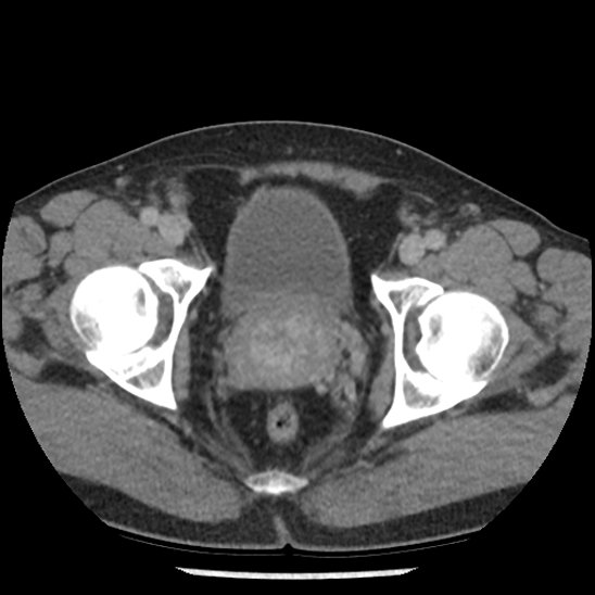Aortic intramural hematoma (type B) (Radiopaedia 79323-92387 Axial C+ delayed 110).jpg