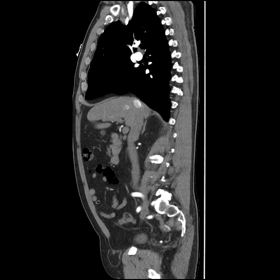 Aortic intramural hematoma (type B) (Radiopaedia 79323-92387 H 18).jpg