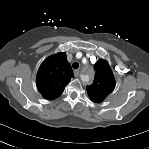 Aortic intramural hematoma from penetrating atherosclerotic ulcer (Radiopaedia 31137-31836 A 14).jpg