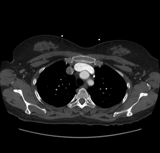 Aortic nipple (Radiopaedia 63008-71449 B 27).jpg