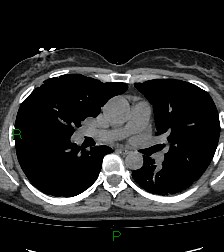 File:Aortic valve endocarditis (Radiopaedia 87209-103485 Axial non-contrast 50).jpg