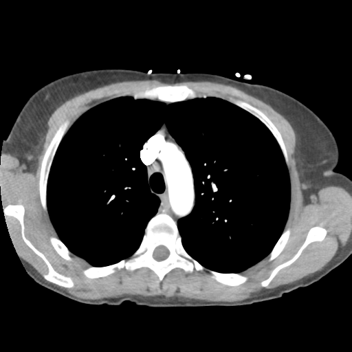 Aortic valve non-coronary cusp thrombus (Radiopaedia 55661-62189 B 15).png
