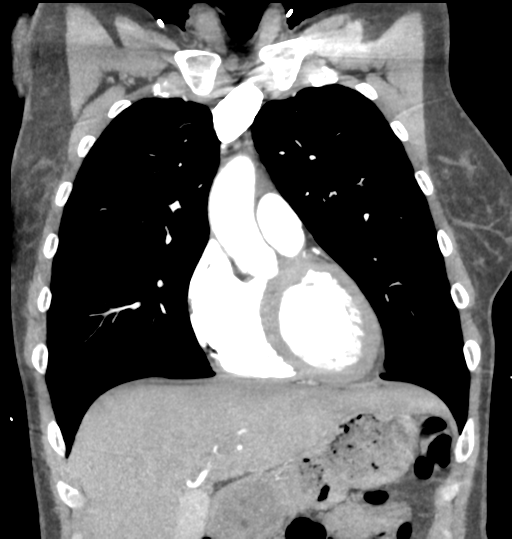 Aortic valve non-coronary cusp thrombus (Radiopaedia 55661-62189 C 27).png